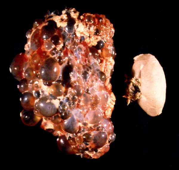 ADPKD kidney compared with normal kidney